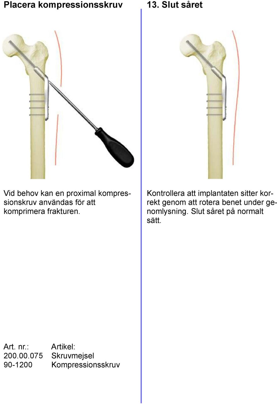 komprimera frakturen.