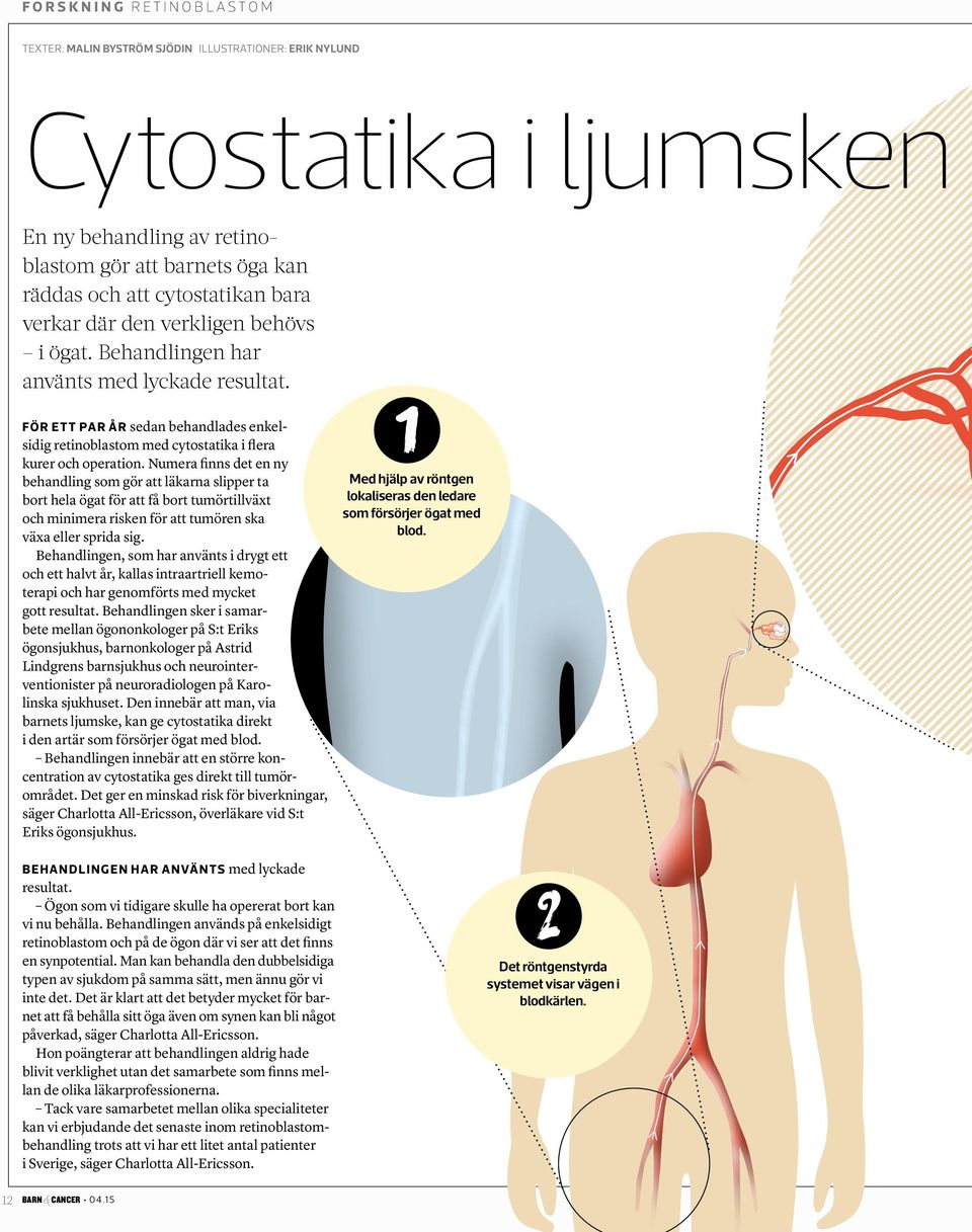 Numera finns det en ny behandling som gör att läkarna slipper ta bort hela ögat för att få bort tumörtillväxt och minimera risken för att tumören ska växa eller sprida sig.