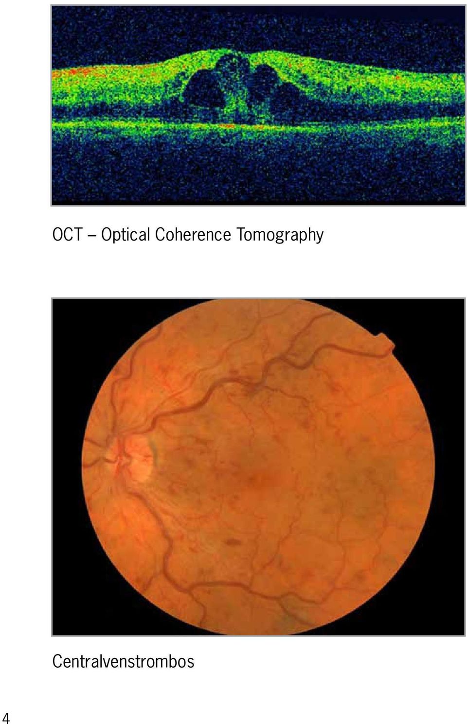 Tomography