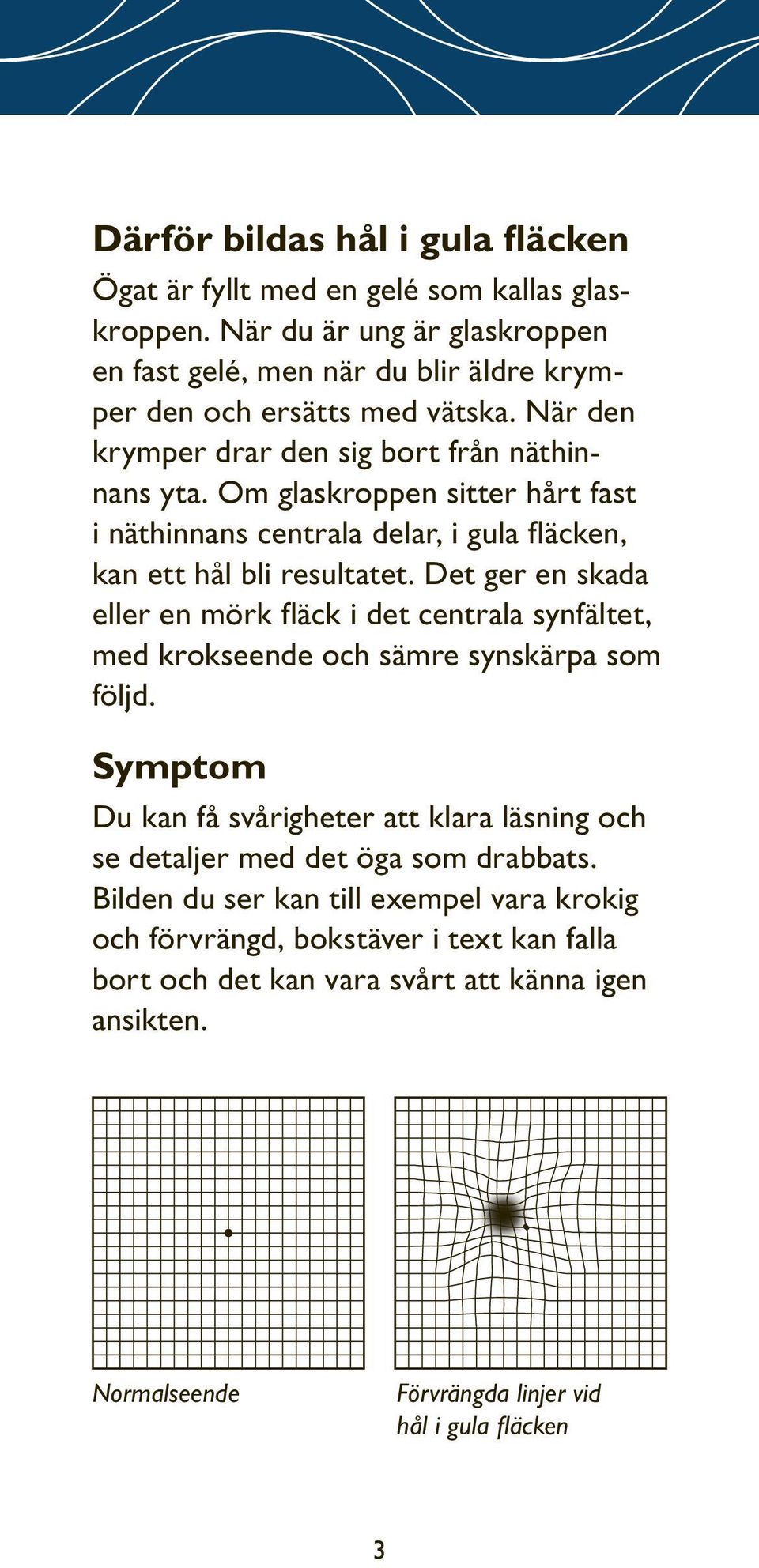 Det ger en skada eller en mörk fläck i det centrala synfältet, med krokseende och sämre synskärpa som följd.