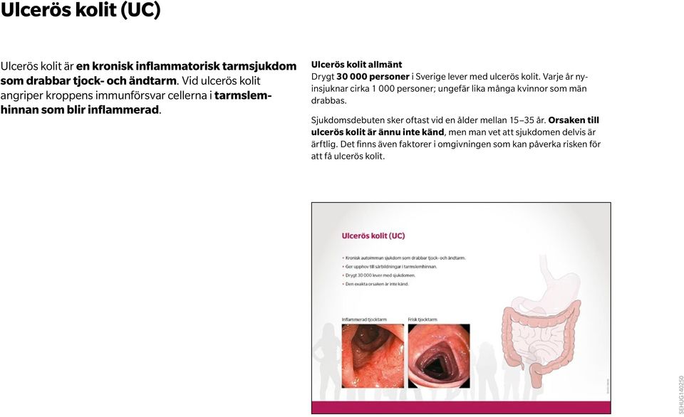 Ulcerös kolit allmänt Drygt 30 000 personer i Sverige lever med ulcerös kolit.