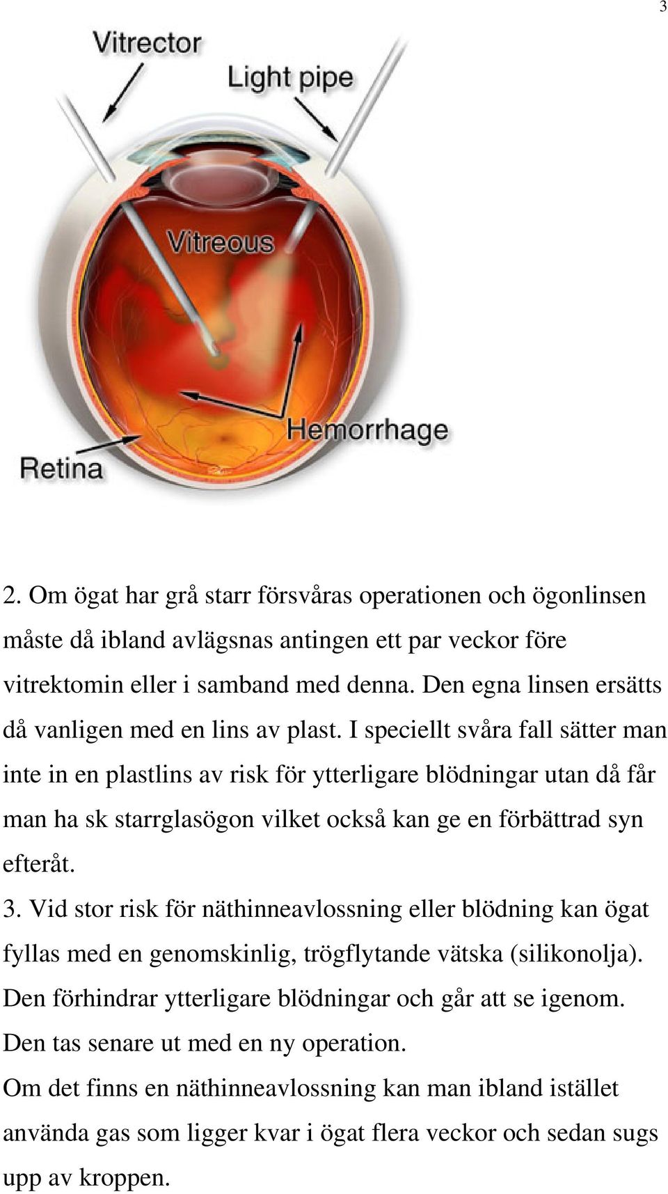 I speciellt svåra fall sätter man inte in en plastlins av risk för ytterligare blödningar utan då får man ha sk starrglasögon vilket också kan ge en förbättrad syn efteråt. 3.