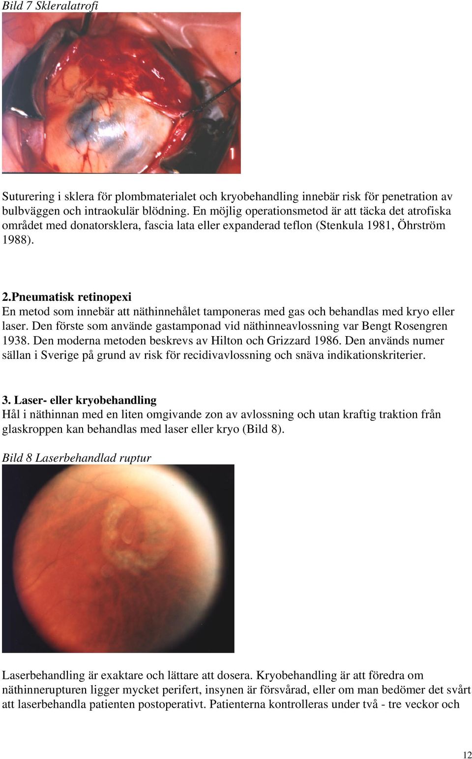 Pneumatisk retinopexi En metod som innebär att näthinnehålet tamponeras med gas och behandlas med kryo eller laser. Den förste som använde gastamponad vid näthinneavlossning var Bengt Rosengren 1938.
