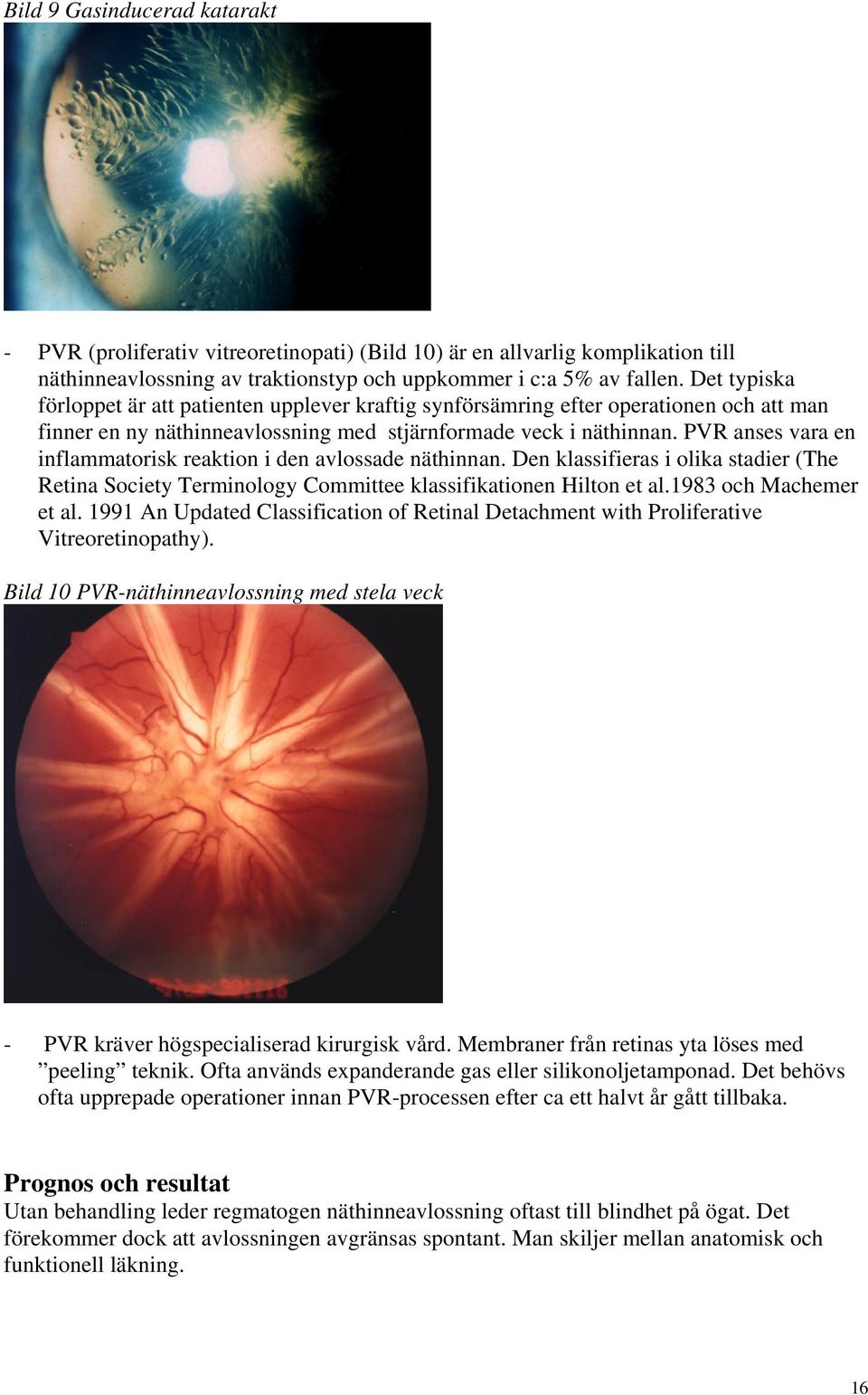 PVR anses vara en inflammatorisk reaktion i den avlossade näthinnan. Den klassifieras i olika stadier (The Retina Society Terminology Committee klassifikationen Hilton et al.1983 och Machemer et al.
