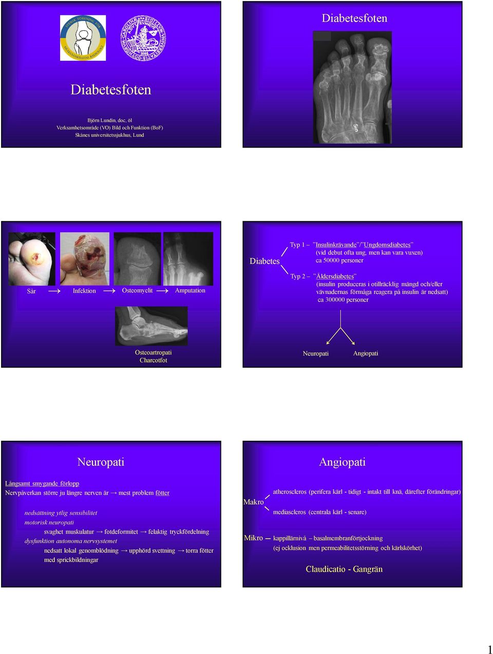 ca 300000 personer Osteoartropati Charcotfot Neuropati Angiopati Neuropati Angiopati Långsamt smygande förlopp Nervpåverkan större ju längre nerven är mest problem fötter nedsättning ytlig