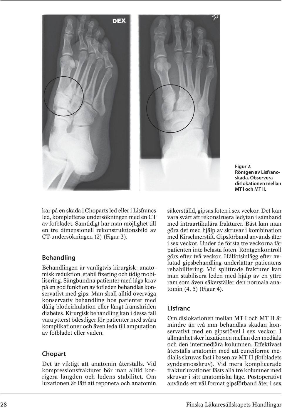 Behandling Behandlingen är vanligtvis kirurgisk: anatomisk reduktion, stabil fixering och tidig mobilisering.