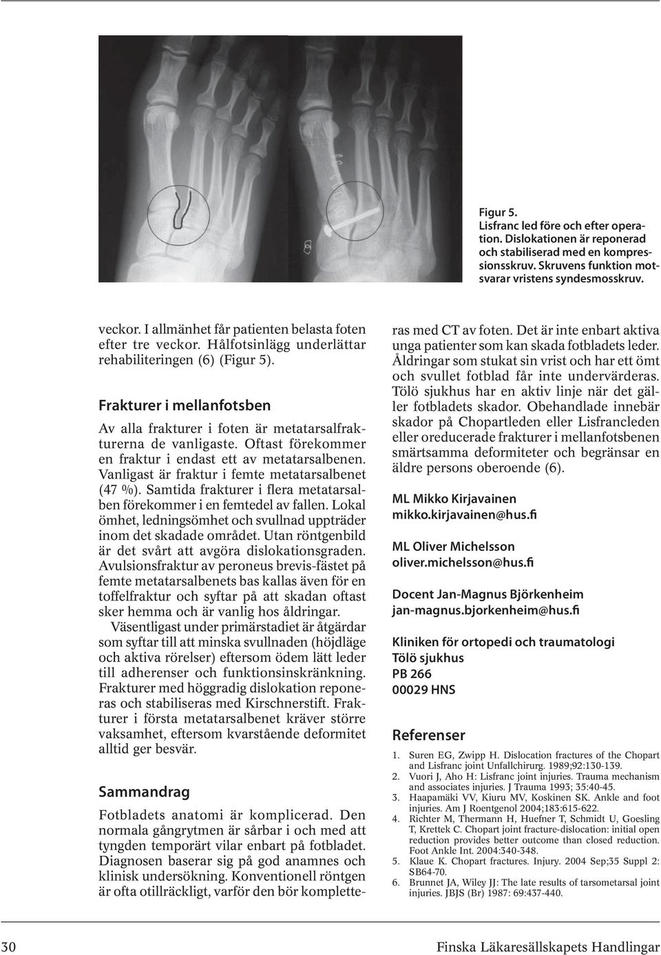 Frakturer i mellanfotsben Av alla frakturer i foten är metatarsalfrakturerna de vanligaste. Oftast förekommer en fraktur i endast ett av metatarsalbenen.