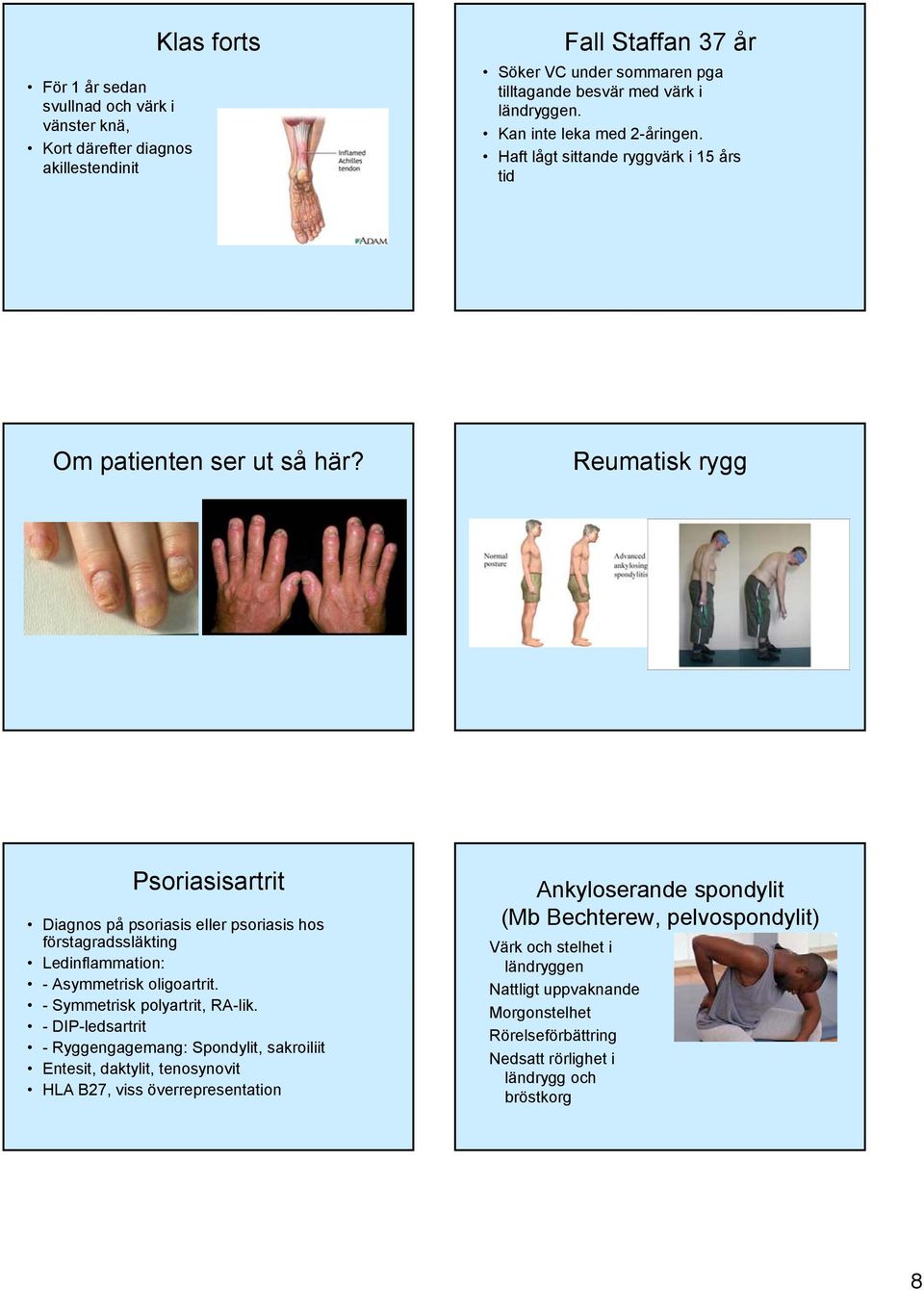 Reumatisk rygg Psoriasisartrit Diagnos på psoriasis eller psoriasis hos förstagradssläkting Ledinflammation: - Asymmetrisk oligoartrit. - Symmetrisk polyartrit, RA-lik.