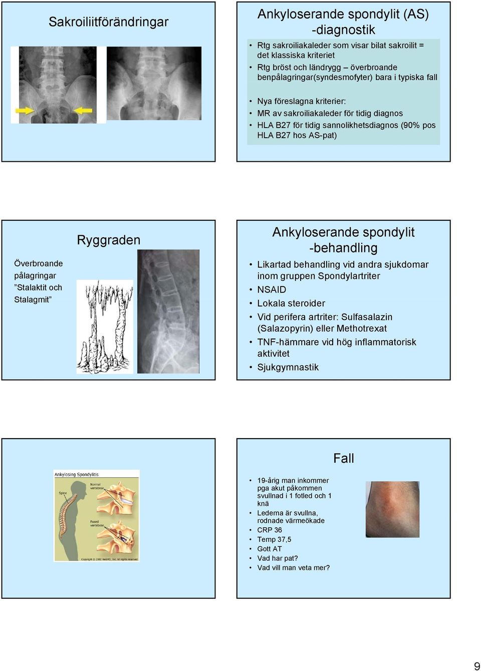 pålagringar Stalaktit och Stalagmit Ryggraden Ankyloserande spondylit -behandling Likartad behandling vid andra sjukdomar inom gruppen Spondylartriter NSAID Lokala steroider Vid perifera artriter: