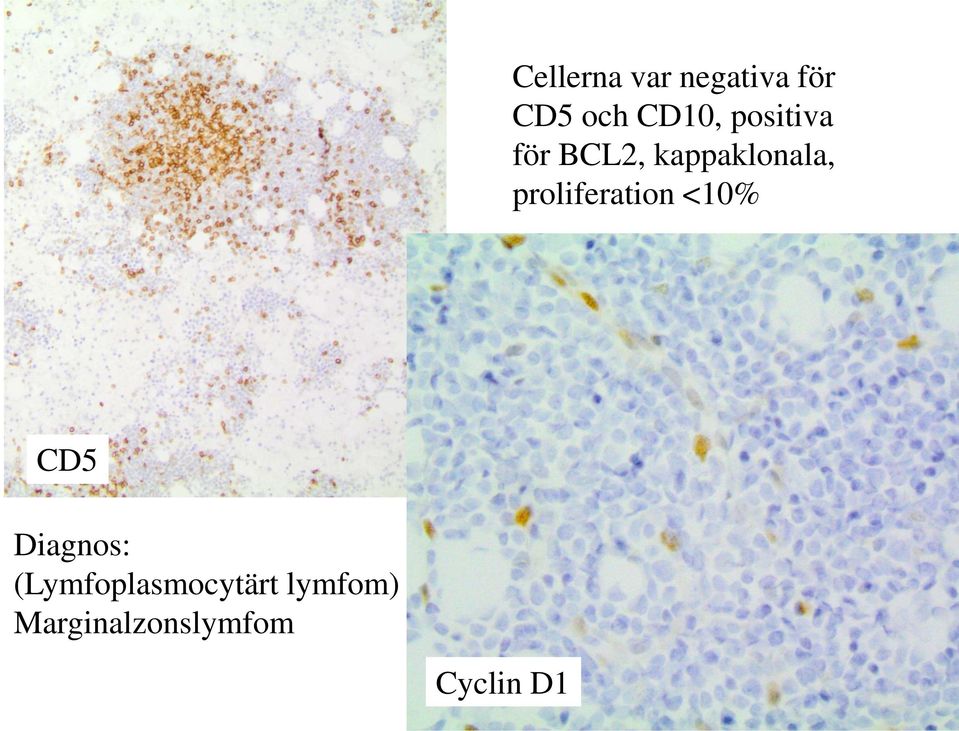 proliferation <10% CD5 Diagnos: