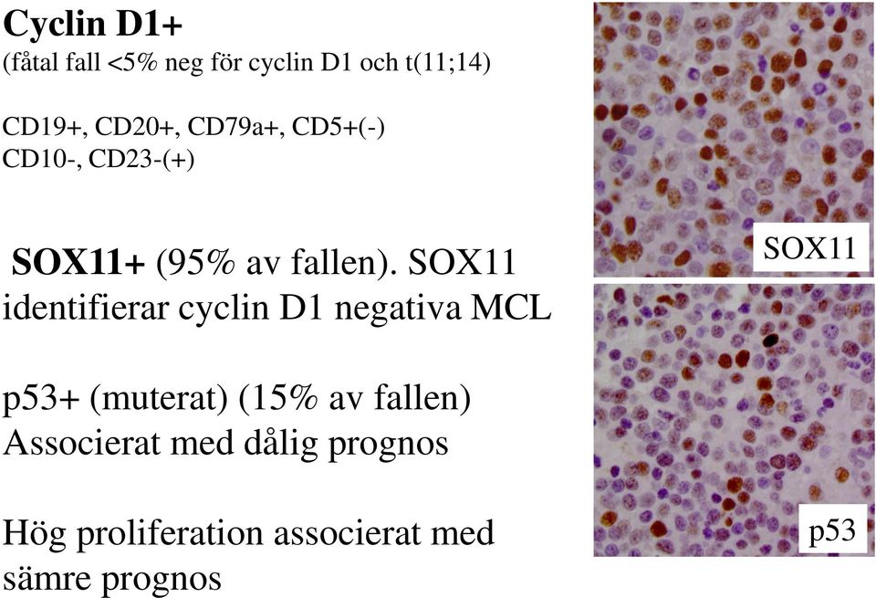 SOX11 identifierar cyclin D1 negativa MCL SOX11 p53+ (muterat) (15% av
