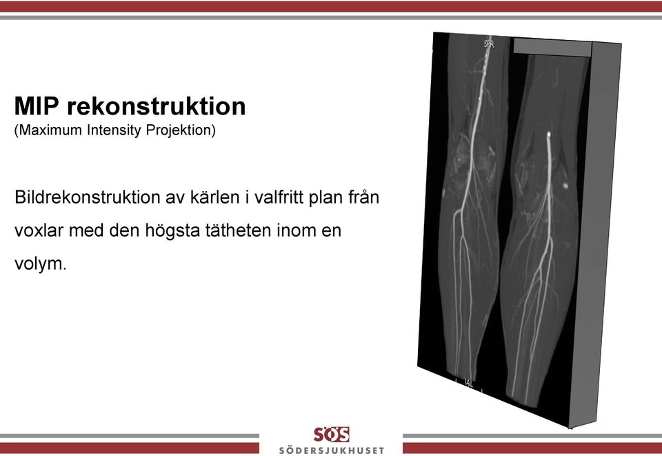 Bildrekonstruktion av kärlen i