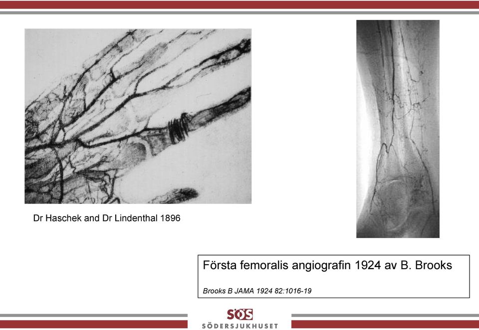 femoralis angiografin 1924