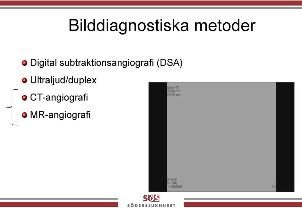 subtraktionsangiografi