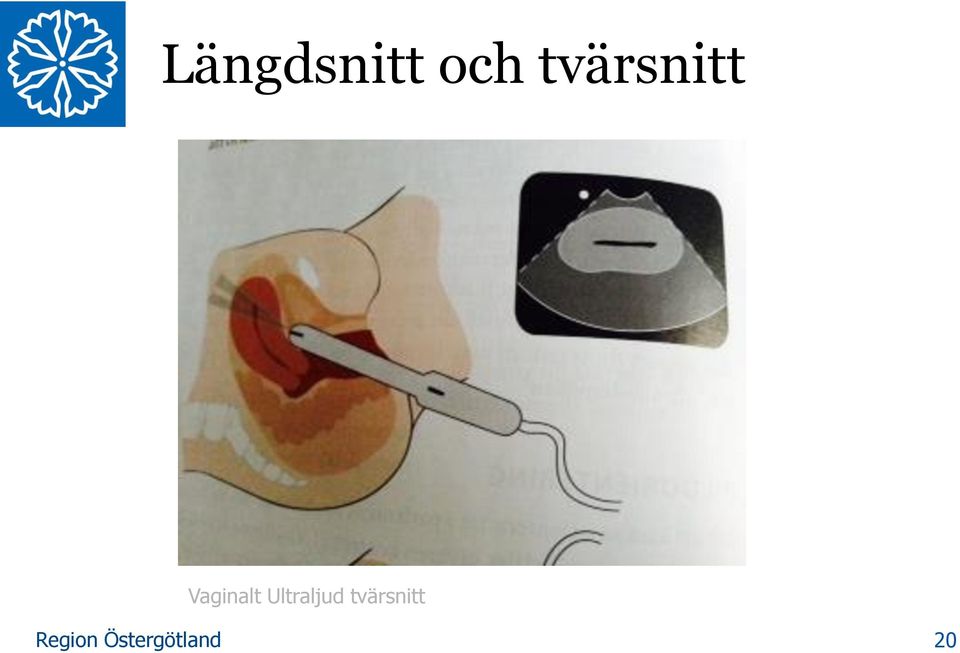 Vaginalt
