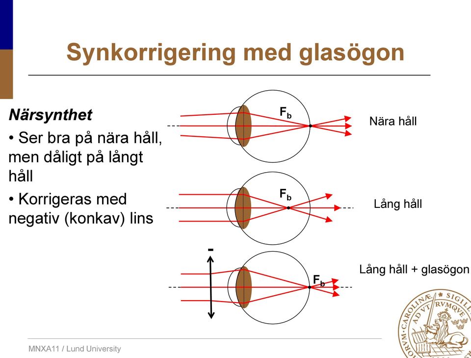 Korrigeras med negativ (konkav) lins F b F b