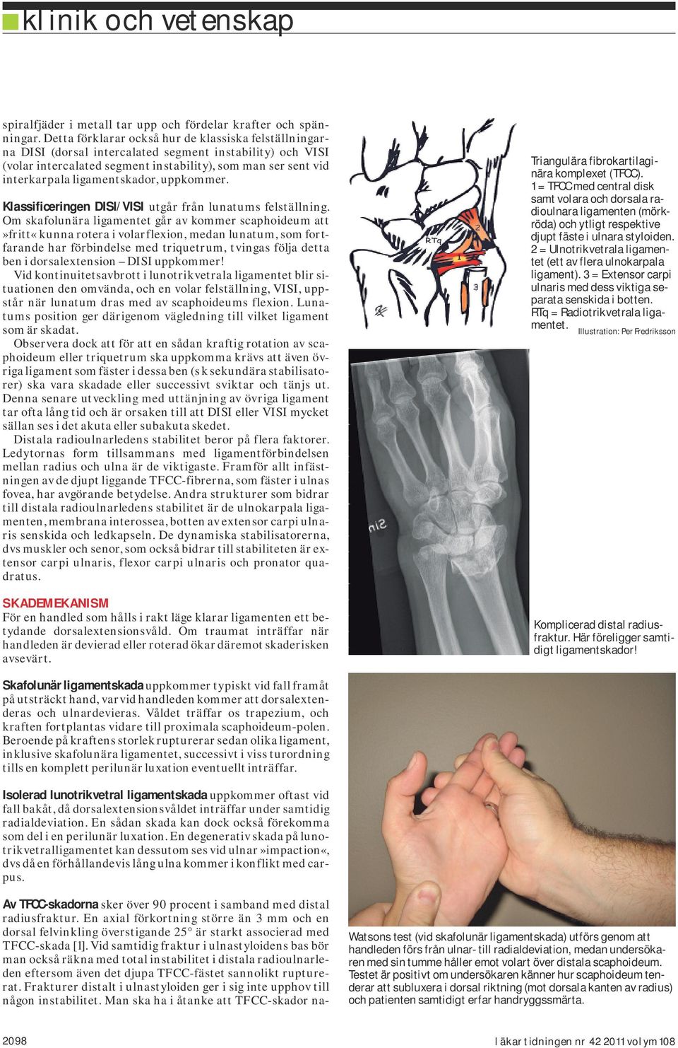 ligamentskador, uppkommer. Klassificeringen DISI/VISI utgår från lunatums felställning.