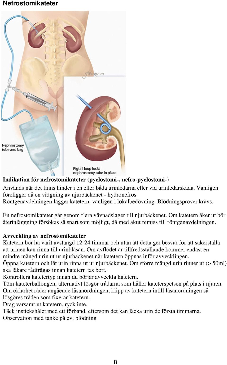 En nefrostomikateter går genom flera vävnadslager till njurbäckenet. Om katetern åker ut bör återinläggning försökas så snart som möjligt, då med akut remiss till röntgenavdelningen.