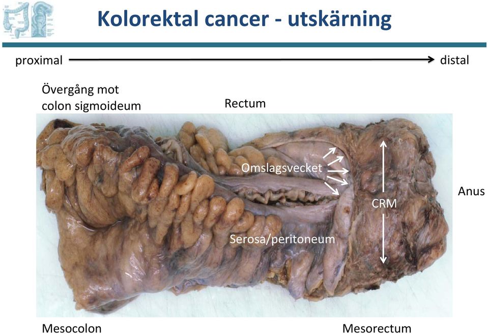 sigmoideum Rectum Omslagsvecket CRM