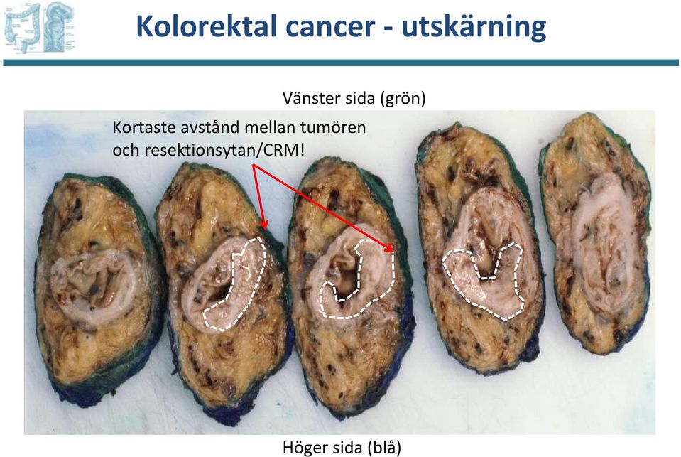 avstånd mellan tumören och