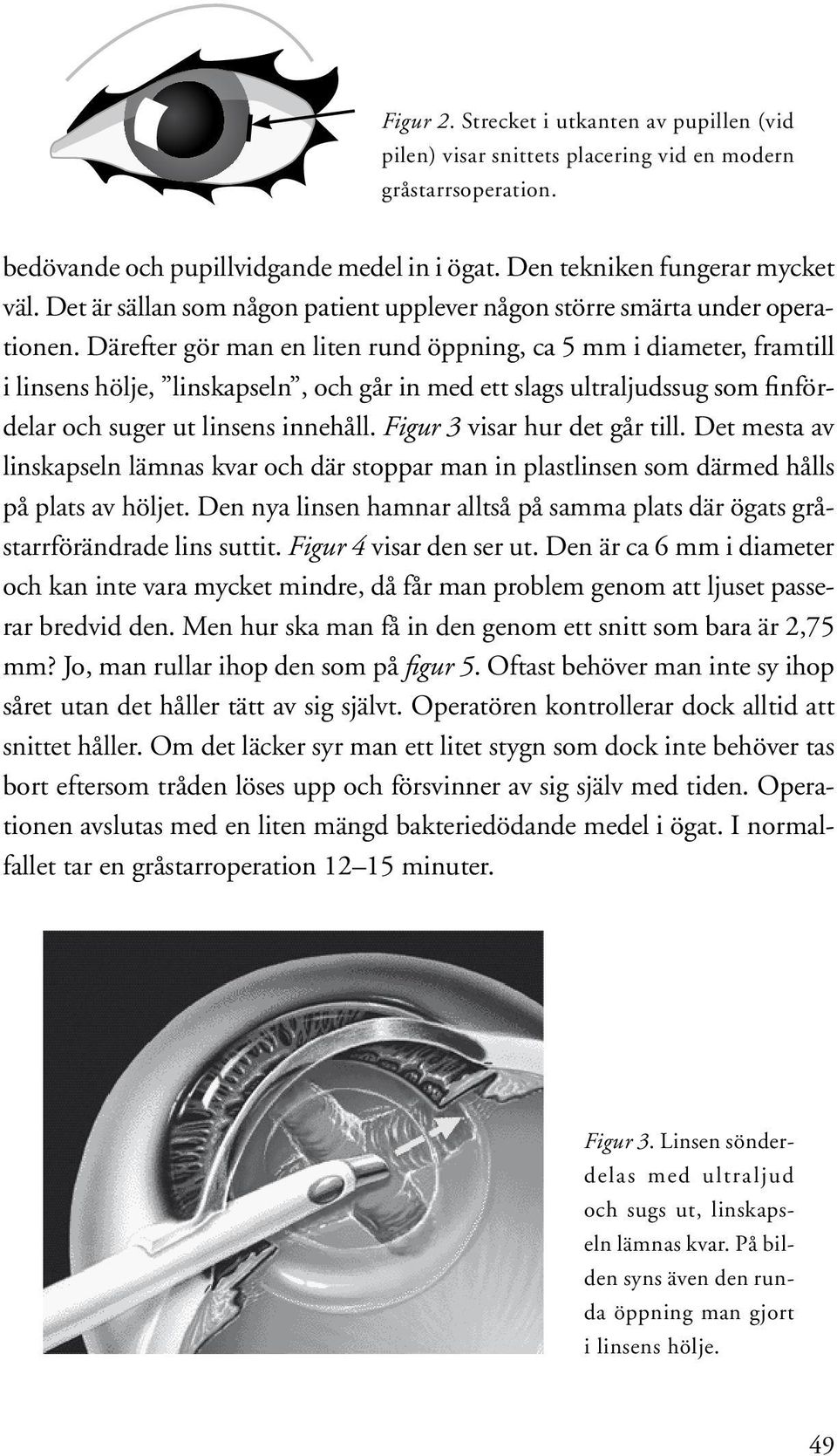 Därefter gör man en liten rund öppning, ca 5 mm i diameter, framtill i linsens hölje, linskapseln, och går in med ett slags ultraljudssug som finfördelar och suger ut linsens innehåll.