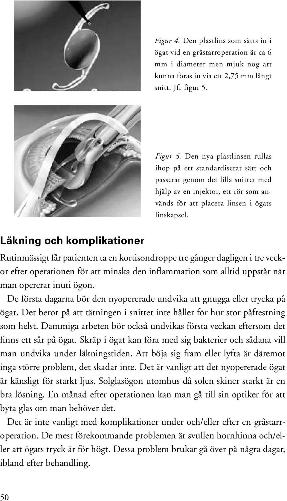 Läkning och komplikationer Rutinmässigt får patienten ta en kortisondroppe tre gånger dagligen i tre veckor efter operationen för att minska den inflammation som alltid uppstår när man opererar inuti