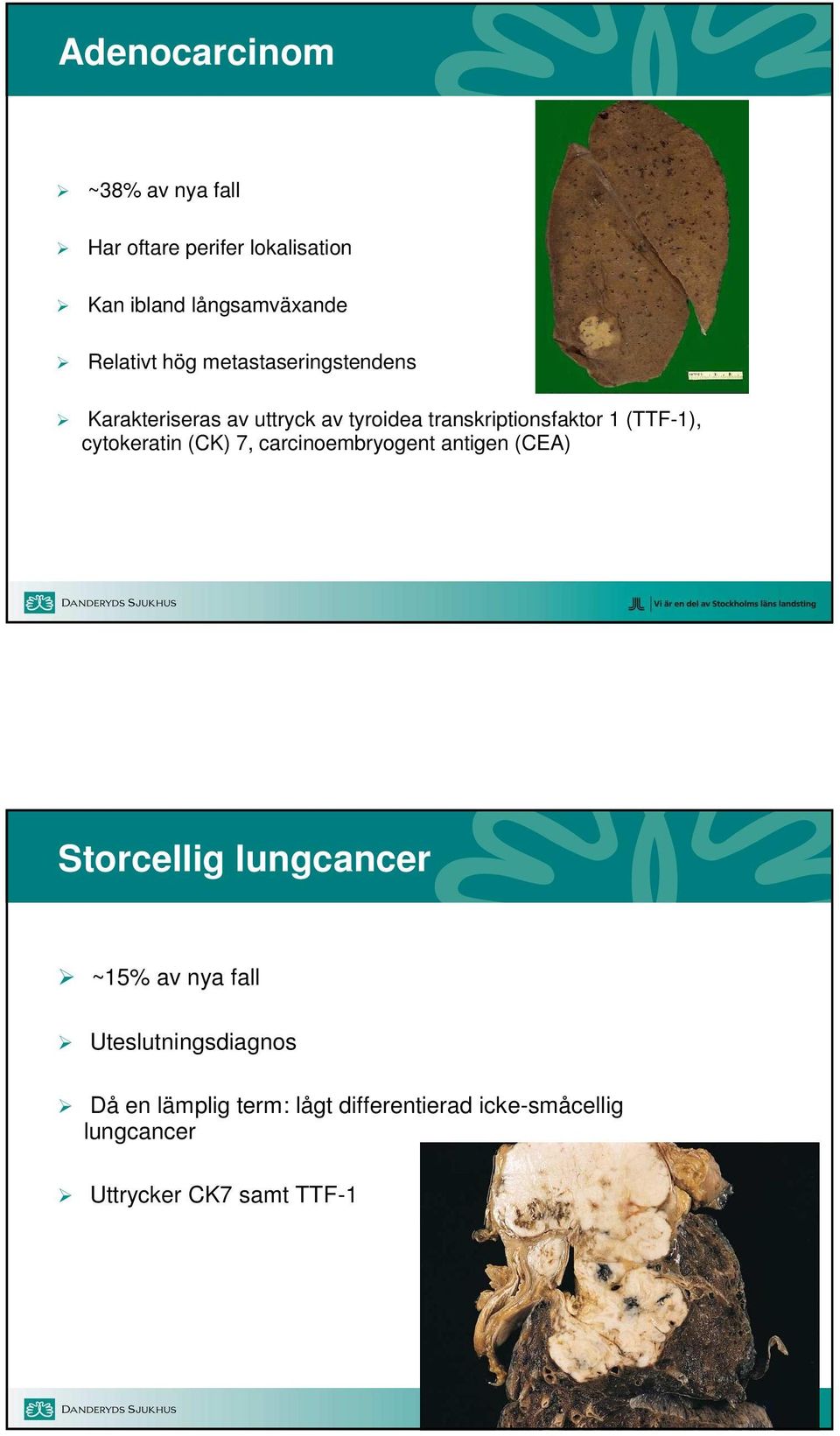 cytokeratin (CK) 7, carcinoembryogent antigen (CEA) Storcellig lungcancer ~15% av nya fall