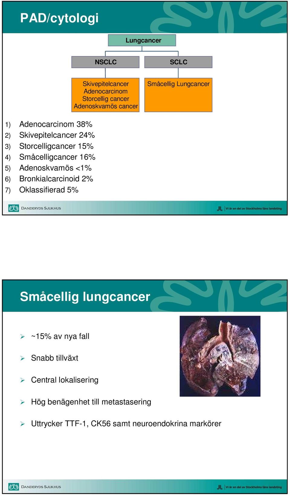 16% 5) Adenoskvamös <1% 6) Bronkialcarcinoid 2% 7) Oklassifierad 5% Småcellig lungcancer ~15% av nya fall