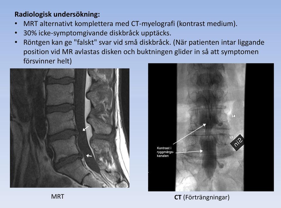 Röntgen kan ge "falskt" svar vid små diskbråck.