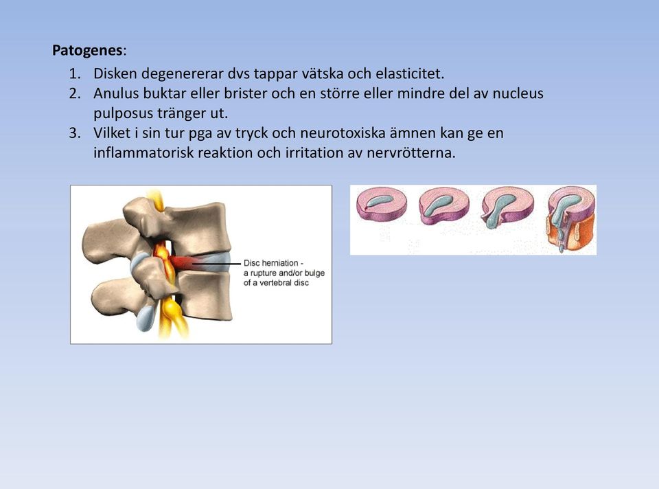 pulposus tränger ut. 3.