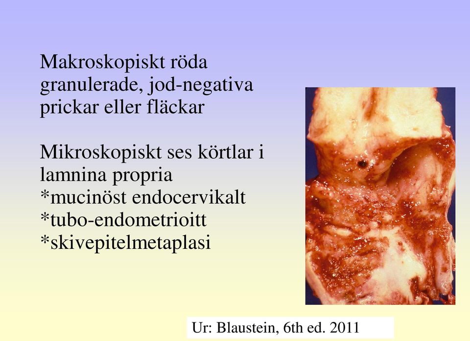 lamnina propria *mucinöst endocervikalt