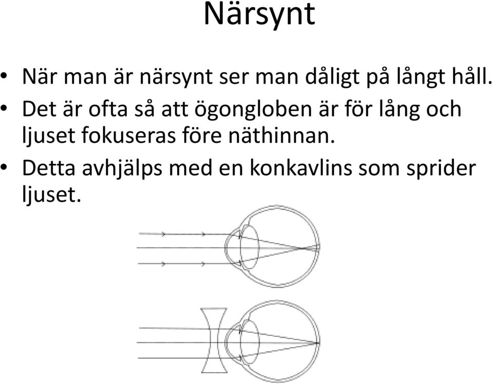 Det är ofta så att ögongloben är för lång och