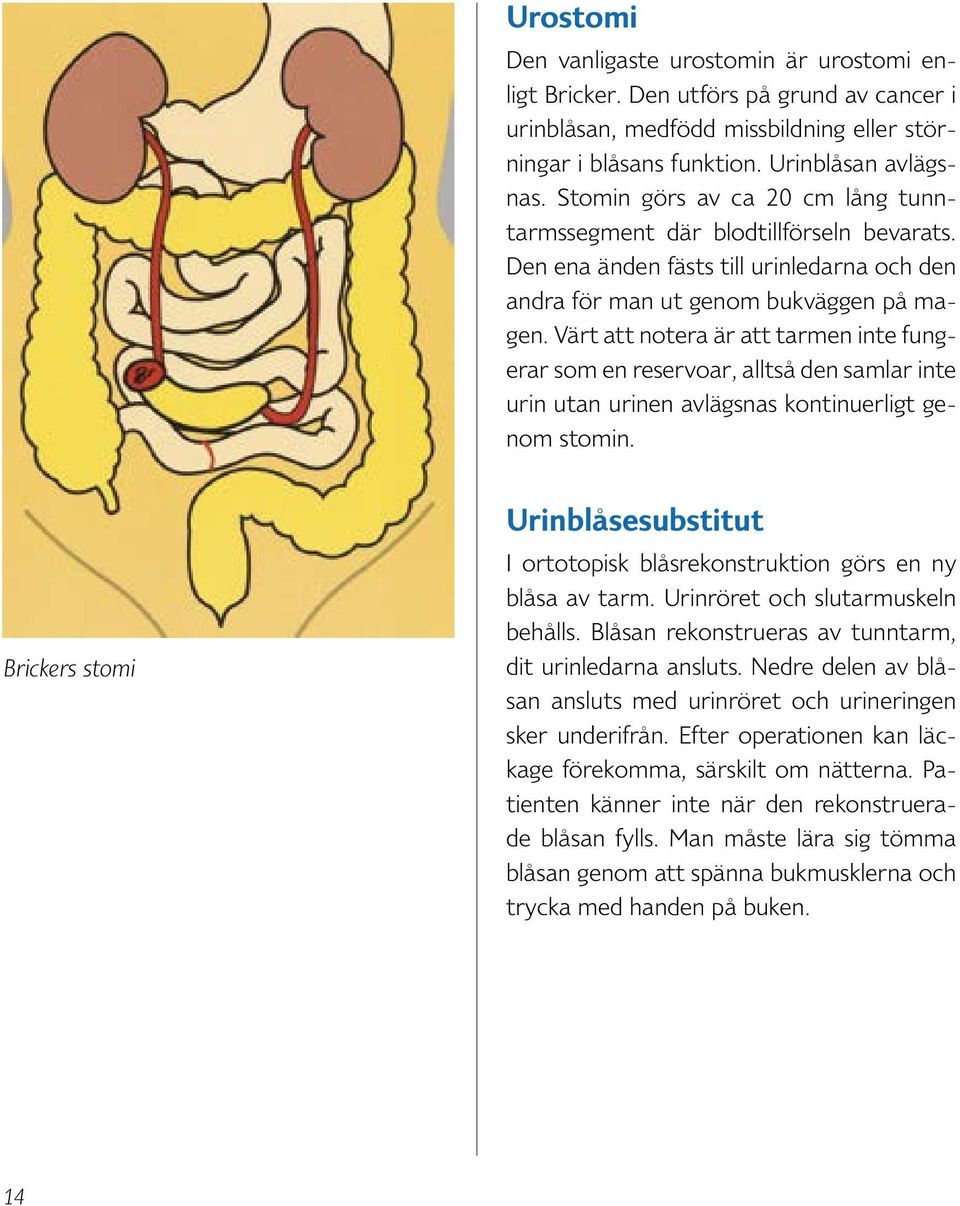 Värt att notera är att tarmen inte fungerar som en reservoar, alltså den samlar inte urin utan urinen avlägsnas kontinuerligt genom stomin.