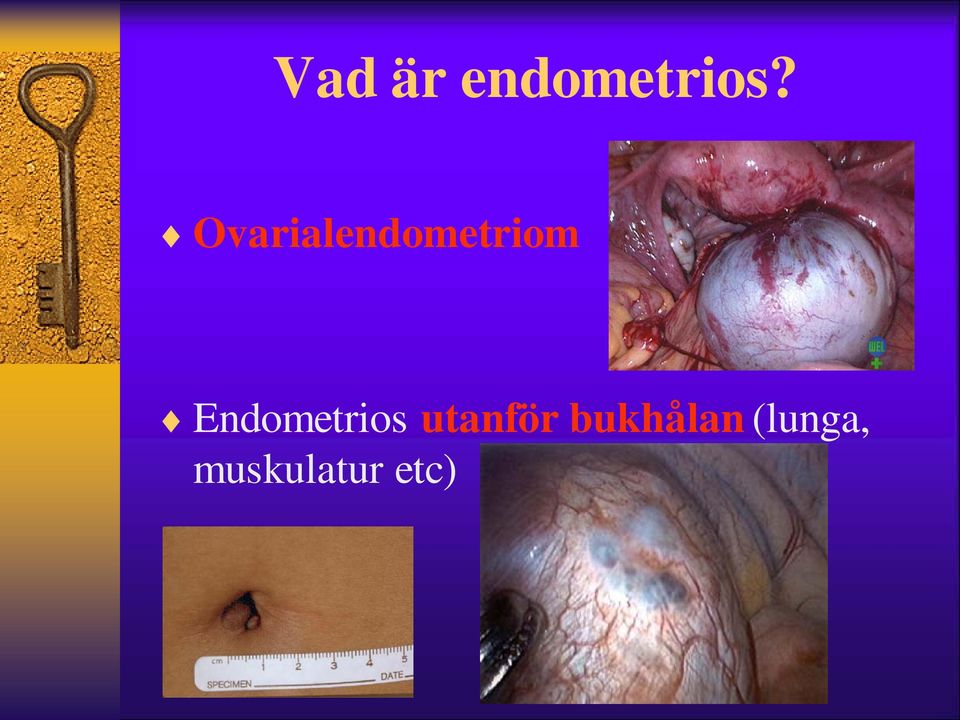 Endometrios utanför