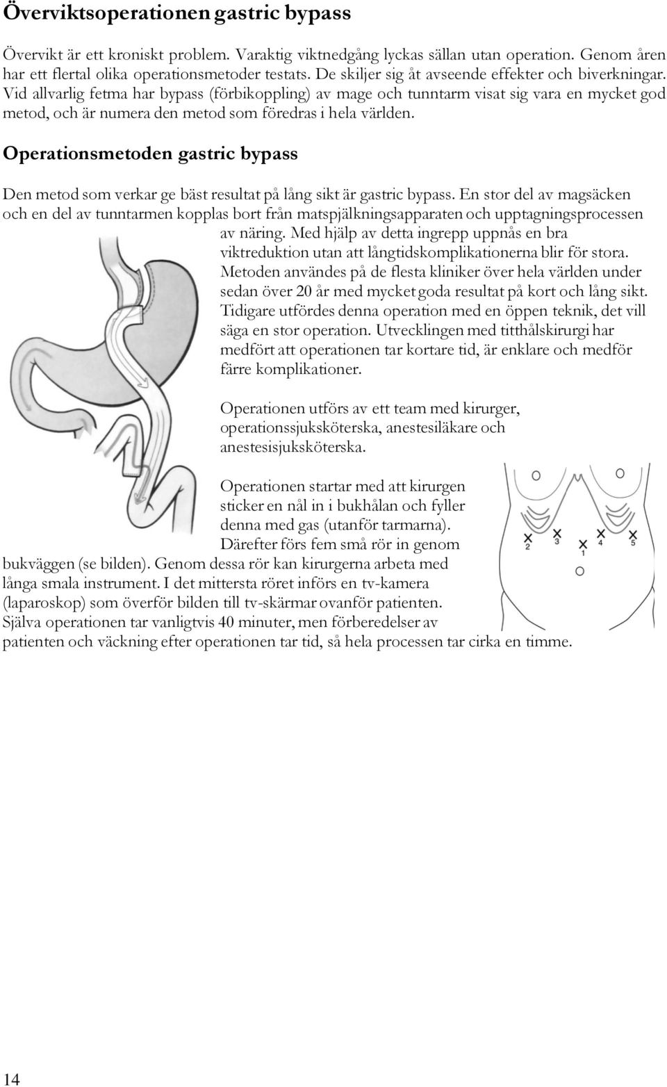 Vid allvarlig fetma har bypass (förbikoppling) av mage och tunntarm visat sig vara en mycket god metod, och är numera den metod som föredras i hela världen.