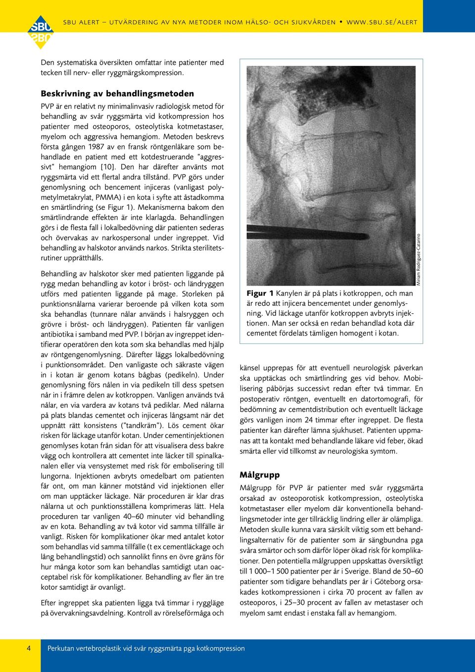 myelom och aggressiva hemangiom. Metoden beskrevs första gången 1987 av en fransk röntgenläkare som behandlade en patient med ett kotdestruerande aggressivt hemangiom [10].