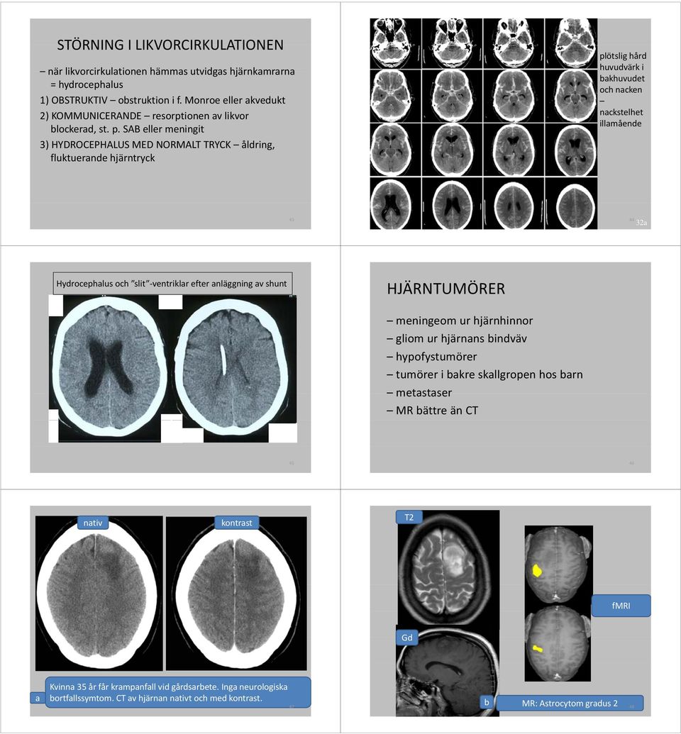 SAB eller meningit 3) HYDROCEPHALUS MED NORMALT TRYCK åldring, fluktuerande hjärntryck plötslig hård huvudvärk i bakhuvudet och nacken nackstelhet illamående 43 44 32a Hydrocephalus och slit