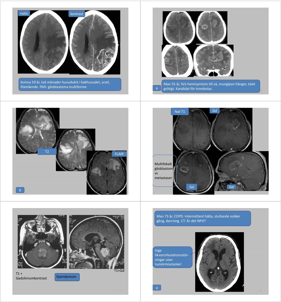 Kandidat för trombolys. 50 Nat T1 Gd T2 FLAIR Multifokalt glioblastom vs metastaser b 51 Gd Gd 52 Man 73 år, COPD.