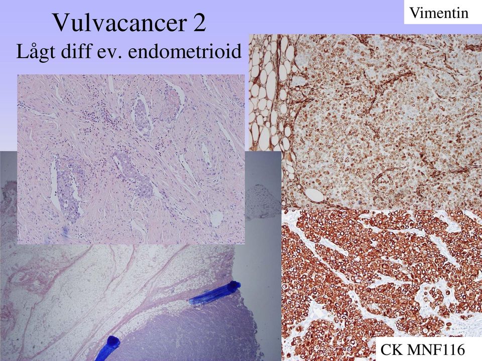 endometrioid