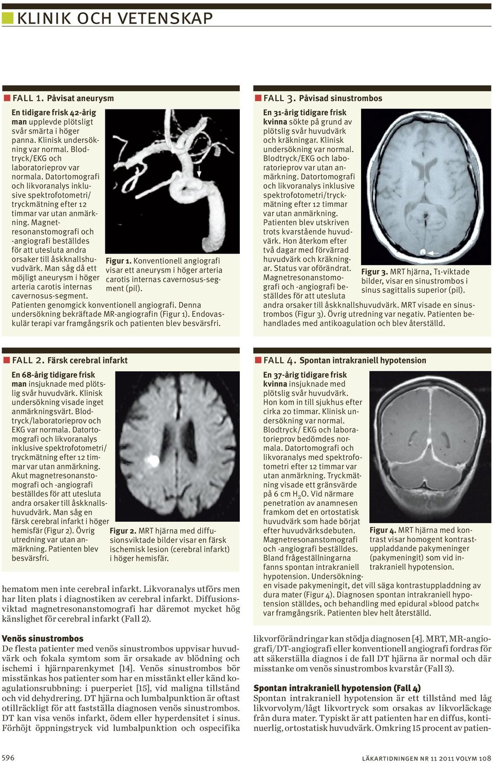 Man såg då ett möjligt aneurysm i höger arteria carotis internas cavernosus-segment. Figur 1. Konventionell angiografi visar ett aneurysm i höger arteria carotis internas cavernosus-segment (pil).