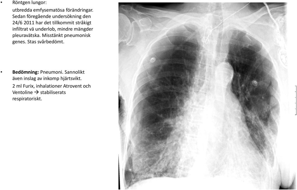 underlob, mindre mängder pleuravätska. Misstänkt pneumonisk genes. Stas svårbedömt.