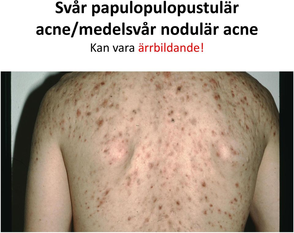 acne/medelsvår