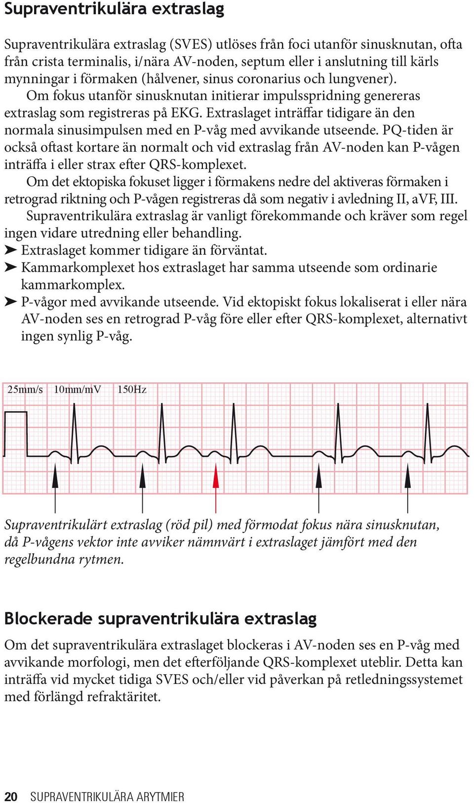 Extraslaget inträffar tidigare än den normala sinusimpulsen med en P-våg med avvikande utseende.