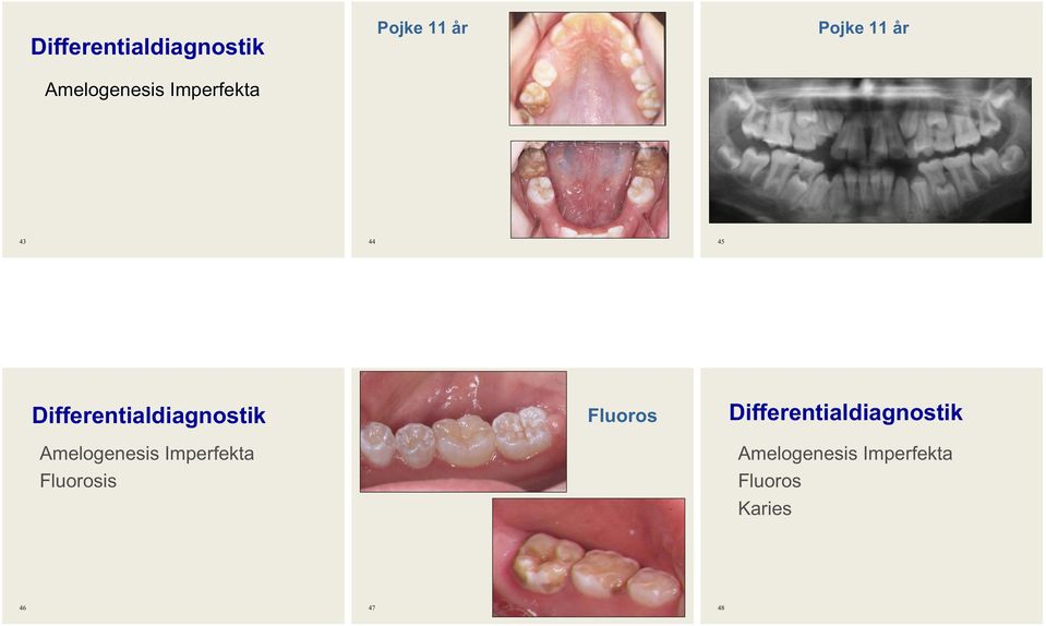 Amelogenesis Imperfekta Fluorosis Fluoros