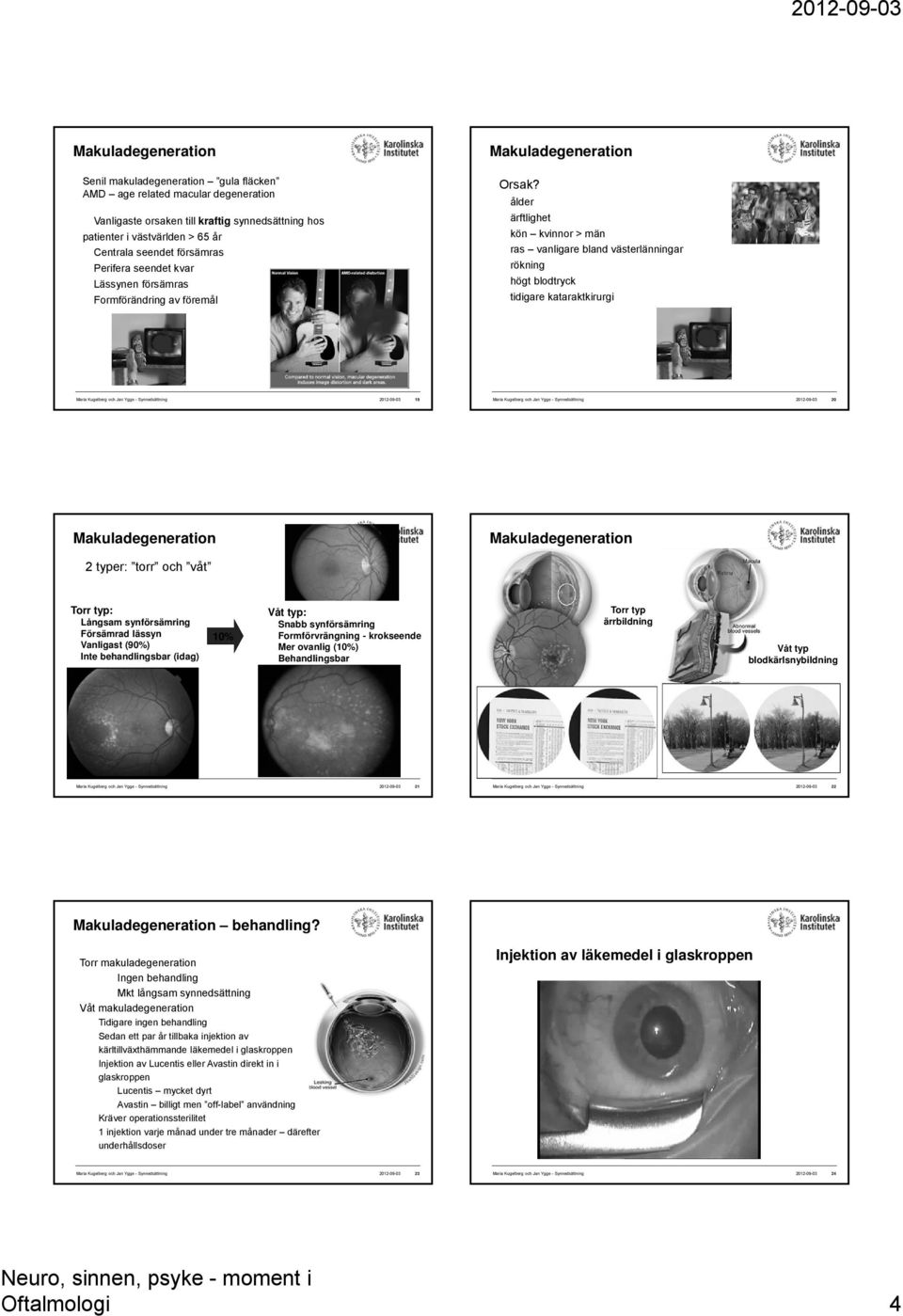 ålder ärftlighet kön kvinnor > män ras vanligare bland västerlänningar rökning högt blodtryck tidigare kataraktkirurgi Maria Kugelberg och Jan Ygge - Synnedsättning 2012-09-03 19 Maria Kugelberg och