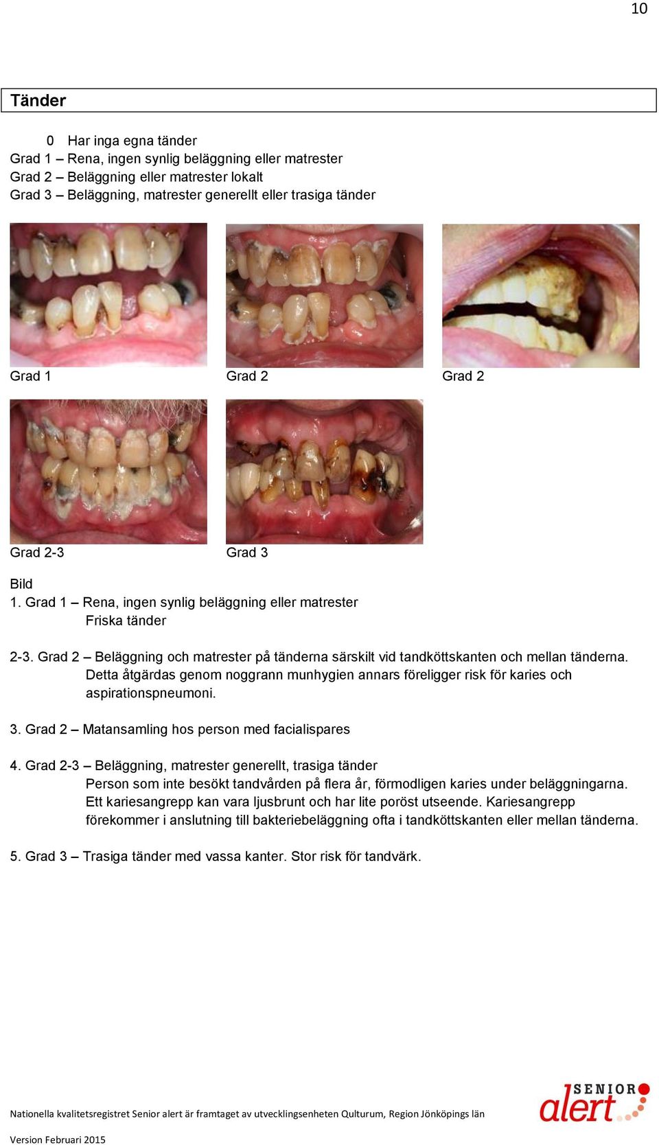 Detta åtgärdas genom noggrann munhygien annars föreligger risk för karies och aspirationspneumoni. 3. Grad 2 Matansamling hos person med facialispares 4.