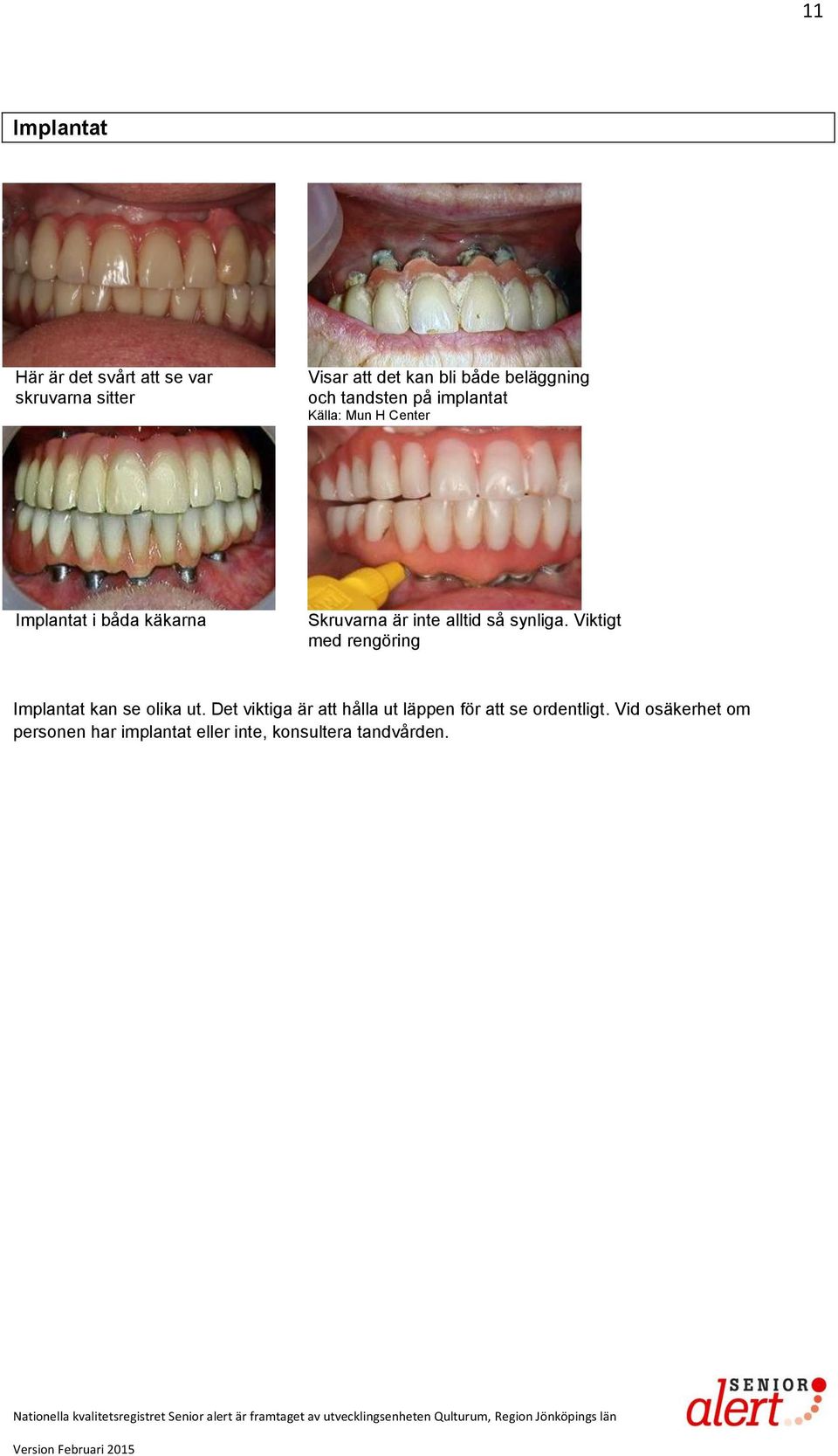 så synliga. Viktigt med rengöring Implantat kan se olika ut.