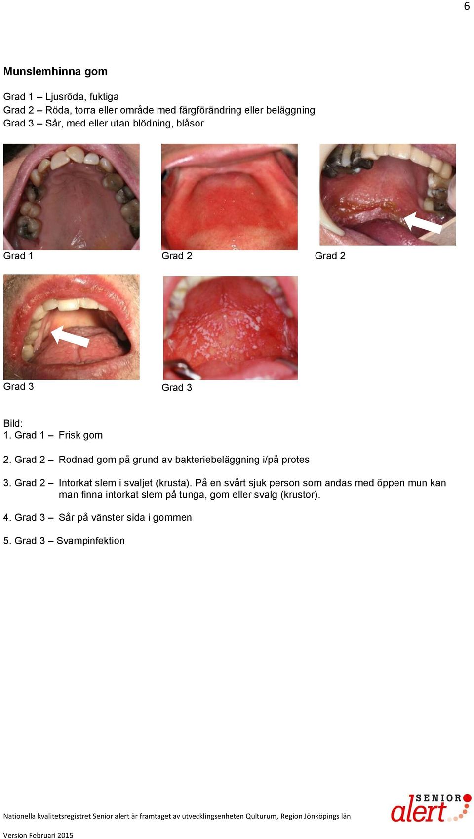 Grad 2 Rodnad gom på grund av bakteriebeläggning i/på protes 3. Grad 2 Intorkat slem i svaljet (krusta).