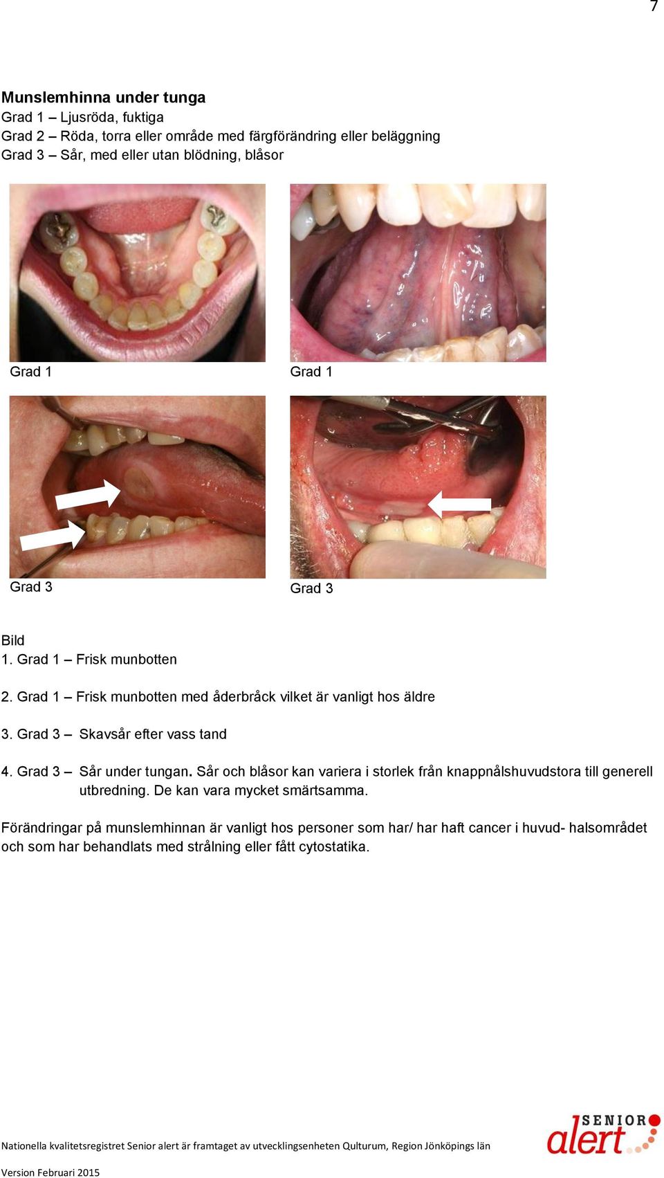 Grad 3 Skavsår efter vass tand 4. Grad 3 Sår under tungan. Sår och blåsor kan variera i storlek från knappnålshuvudstora till generell utbredning.