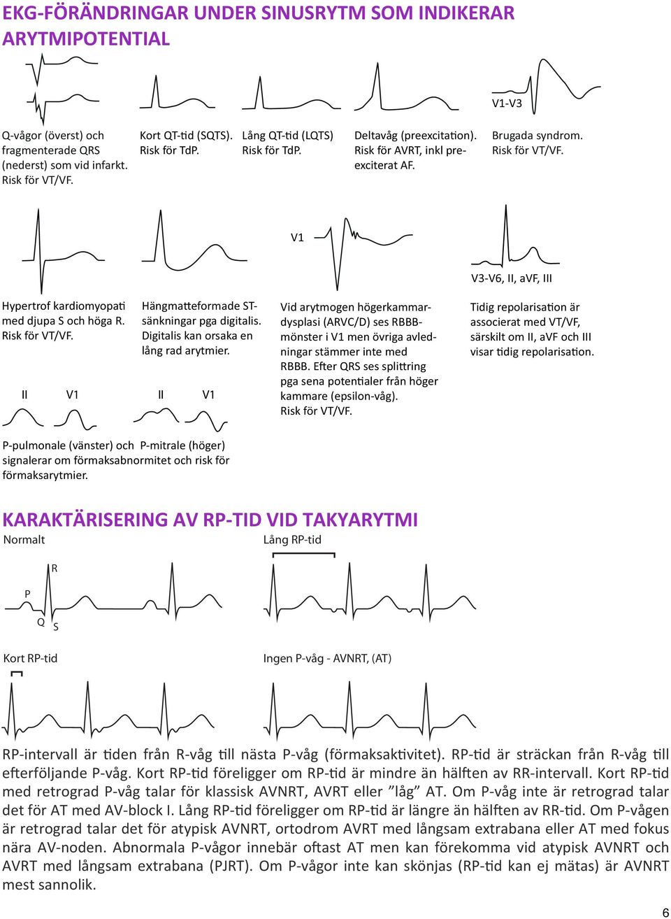 Risk för VT/VF. II V1 Hängma eformade STsänkningar pga digitalis. Digitalis kan orsaka en lång rad arytmier.